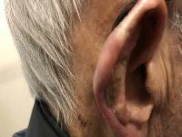 Brachytherapy Proves Effective in Treating Skin Cancer