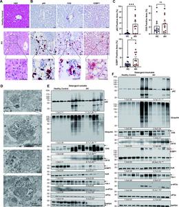 Increased p62, CK8 and G3BP1 protein aggregation in patients with AH.