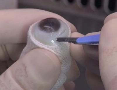 Excision of Cornea