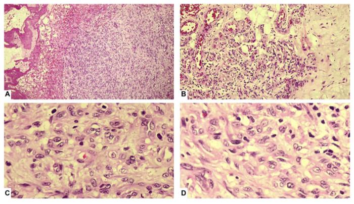 Epithelioid hemangioendothelioma: A rare mimicker of post-traumatic hematoma