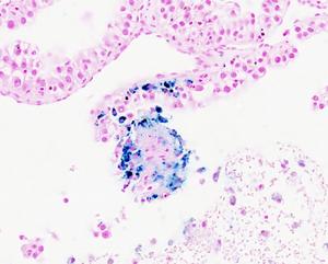 Cancer cells commandeer iron-recycling macrophages