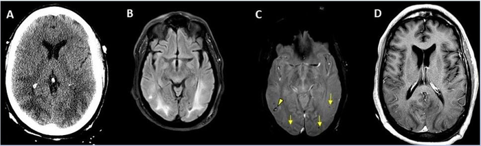Large International Study Reveals Spectrum of COVID-19 Brain Complications