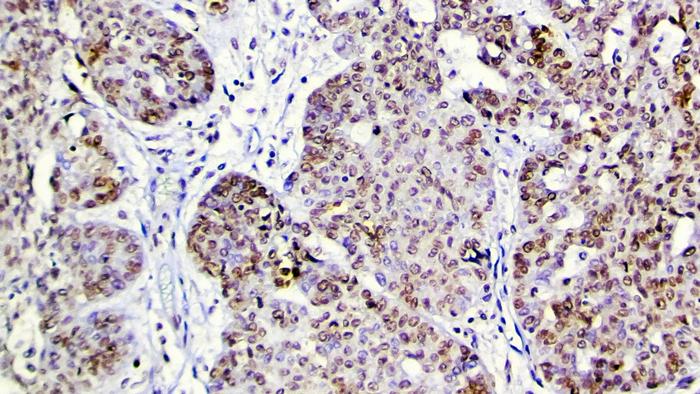PARP1 acetylation in ovarian tumor tissue