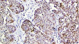 PARP1 acetylation in ovarian tumor tissue