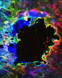 Bone Lesion 