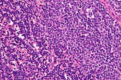 CLL Cells