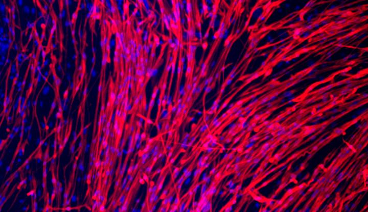 Myotubes differentiated from an iPSC line derived from a T2D patient