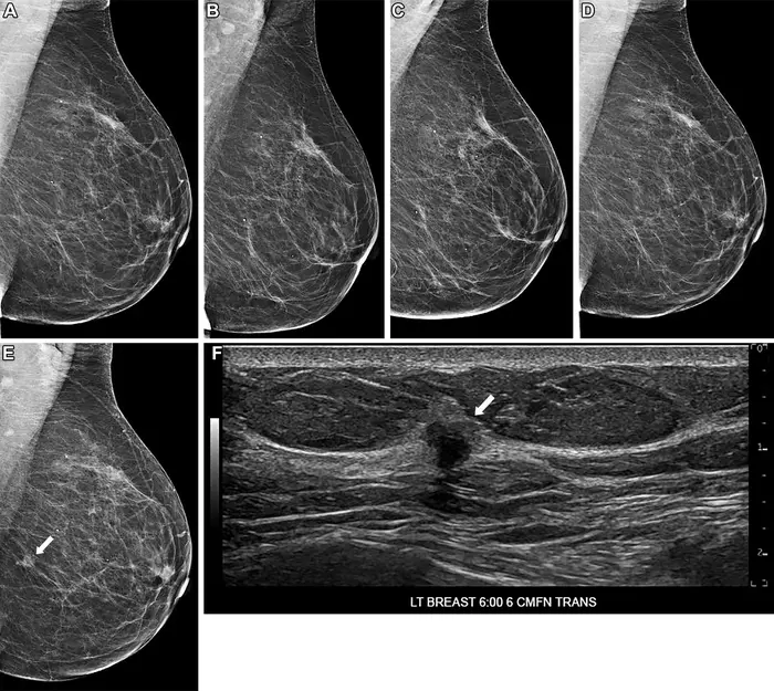 Screening mammograms in a 75-year-old woman over 6 years