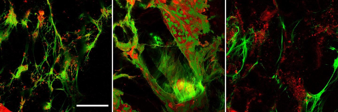 Neutrophil Extracellular Traps