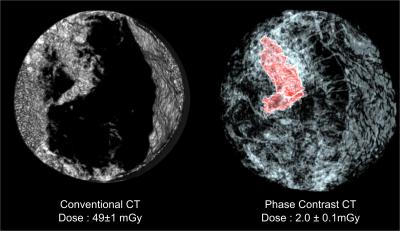 Comparison between Convential and EST Scan