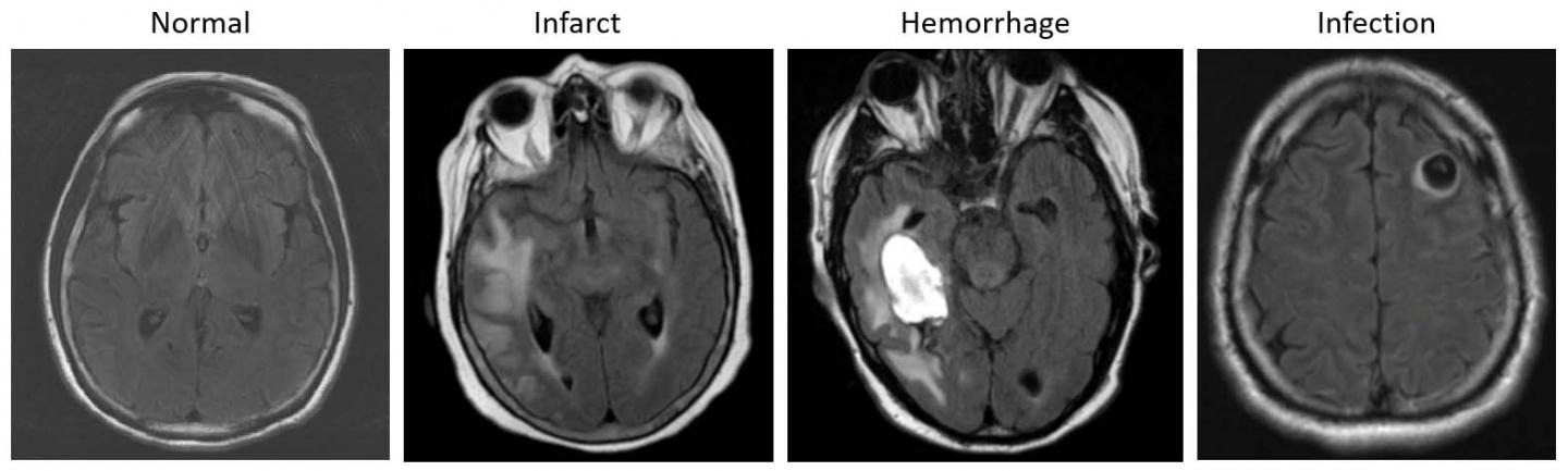 AI-based System Could Help Triage Brain MRIs