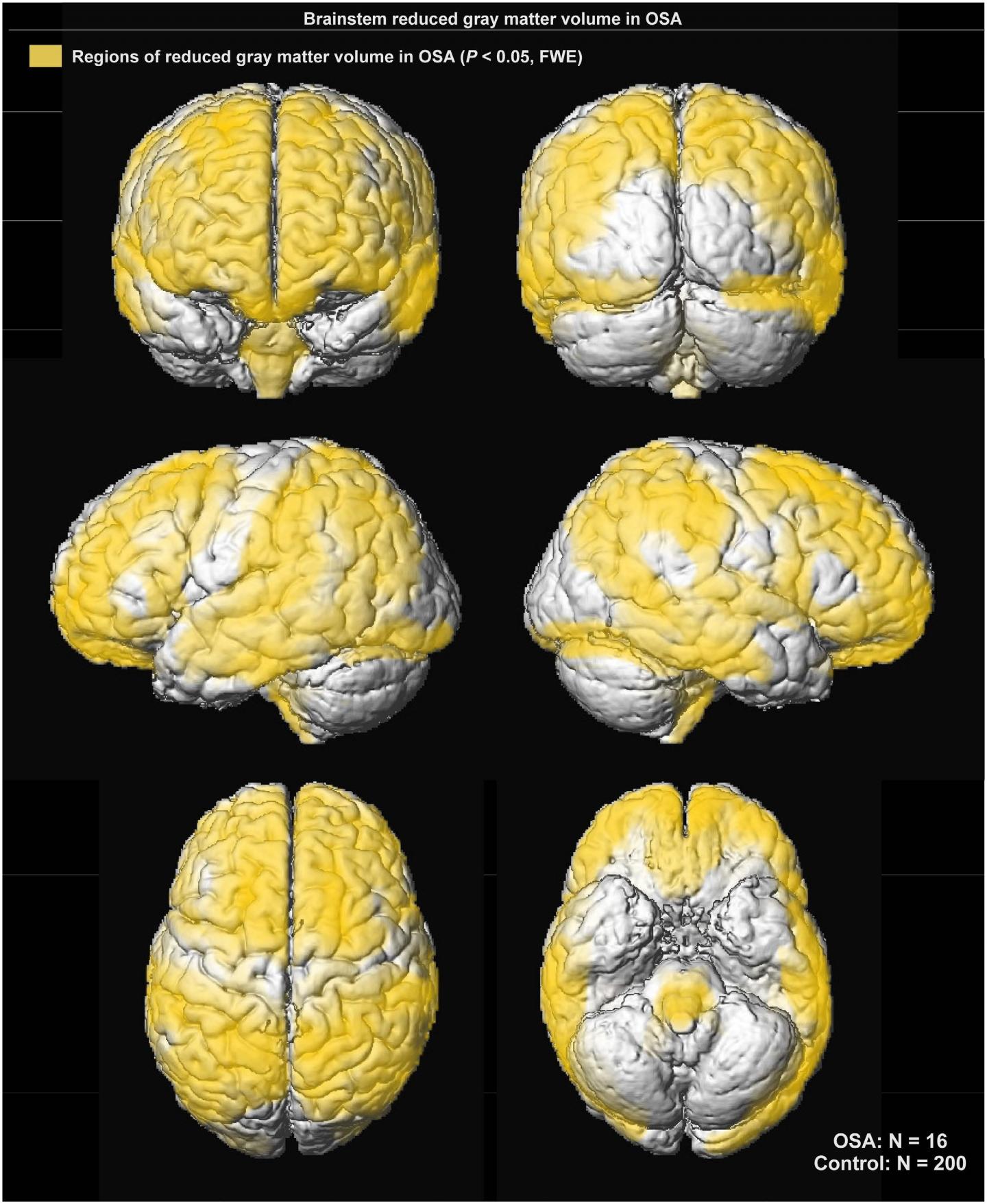 MRI Scans of Gray Matter Volume