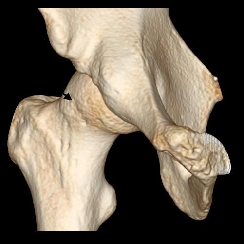 Scan of Right Hip
