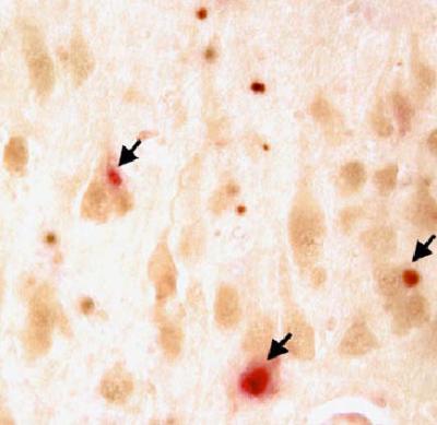 Alzheimer's Brain Tissue