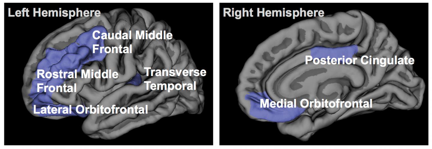 Insomnia Therapy and Gray Matter