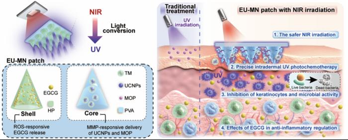 Core-shell structured light-converting microneedle patch for the treatment of psoriasis lesions