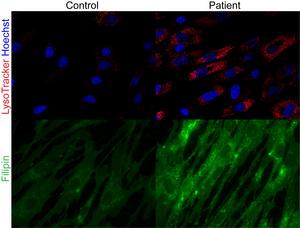 SPNS1 mutations