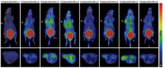 RET-targeted PET tracer highlights neuroendocrine prostate cancer tumors.