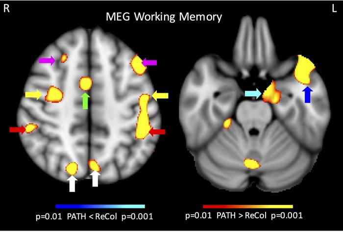 Brain Imaging Shows How Visual Training Improves Cognitive Function After Concussion