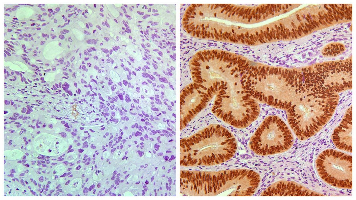 Stage II Colon Cancer