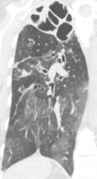 <i>Pseudomonas</i> in Lung