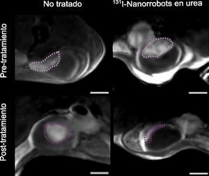 4_Reducción tamaño tumor post-tratamiento