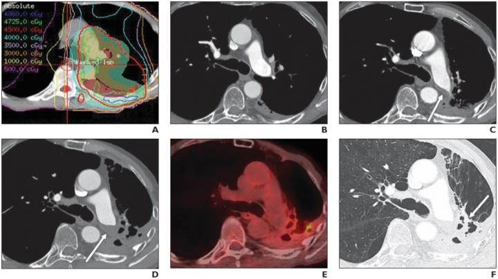 68-Year-Old Man With Lung Cancer in Left Lower Lobe Treated With RT