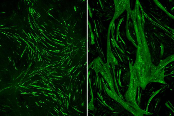 Rare Muscle Dystrophy