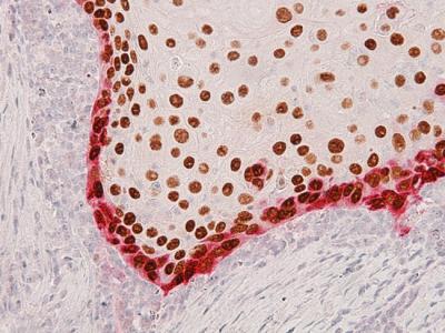 Head and Neck Tumor