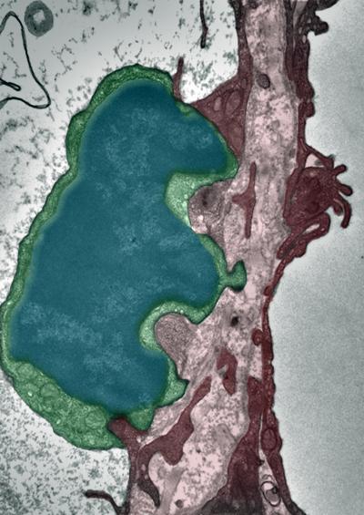 Tumor Cell (1 of 2)
