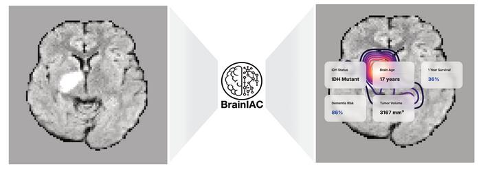 Original MR slice of a human brain (grayscale, left), saliency contour overlay (right), with a logo (line drawing) of BrainIAC (center)