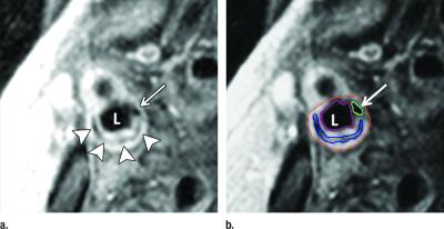 Transverse Gadolinium-enhanced T1-weighted MR