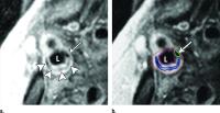 Transverse Gadolinium-enhanced T1-weighted MR