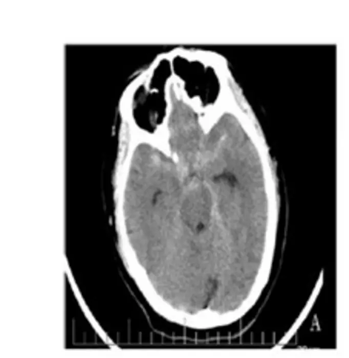 Treatment of the right posterior communicating artery aneurysm with LVIS stent-assisted coiling
