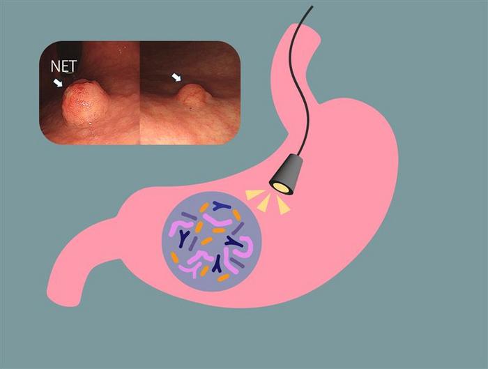 Researchers took biopsies of AIG patients with and without neuroendocrine tumor growth to understand their bacterial communities.