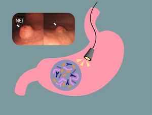 Researchers took biopsies of AIG patients with and without neuroendocrine tumor growth to understand their bacterial communities.