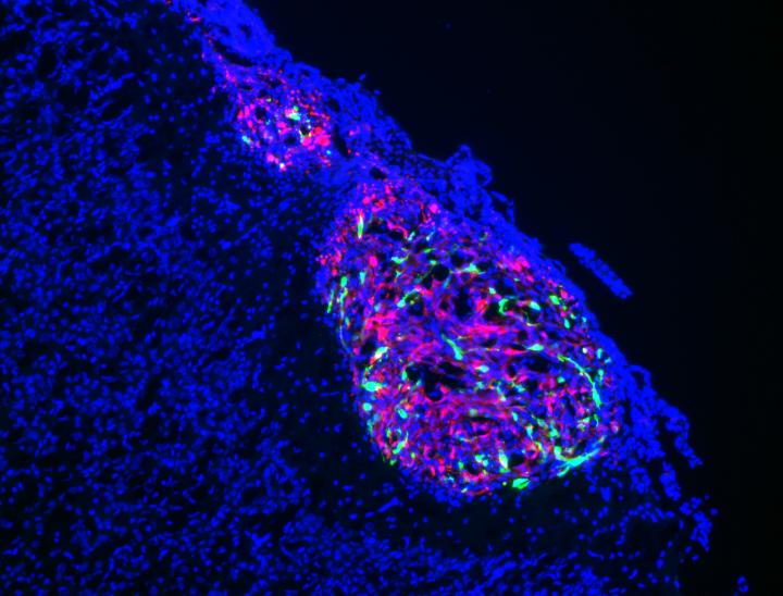 Glioblastoma Cells