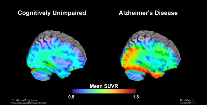 PET scan cognitively unimpaired vs. Alzheimer's disease