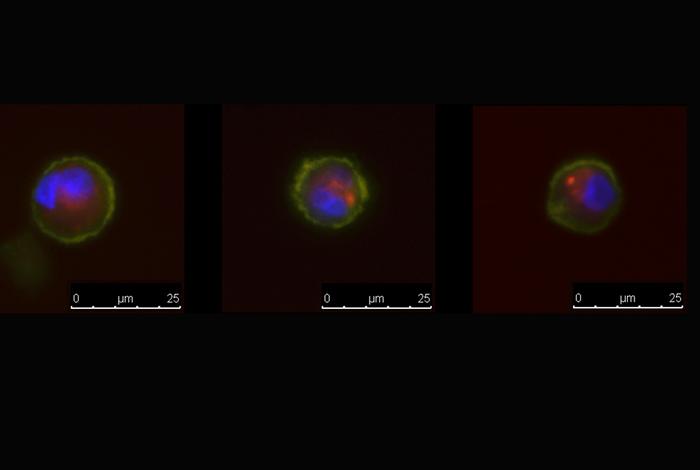 Unusual Tumor Cells May Be Overlooked Factors in Advanced Breast Cancer