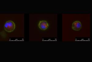 Unusual Tumor Cells May Be Overlooked Factors in Advanced Breast Cancer