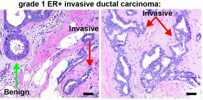 Malignant Tissue