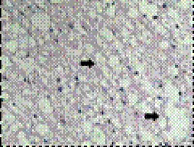 Syringomyelia and Glial Scar