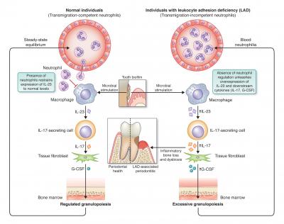 IL-17 Cytokine Plays Key Role in LAD-associated Tooth Bone Loss