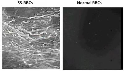 Sickle Cells and Normal Cells in Tumors