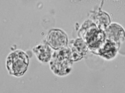 Dying Beta Cells