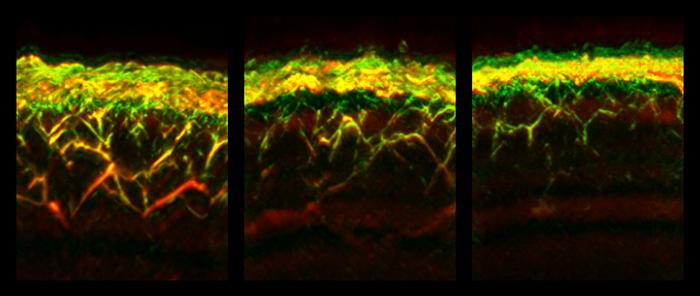 RSOM images of the skin of a healthy volunteer (left), a patient with diabetes (center) and a patient with neuropathy (right).