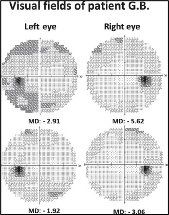 Visual fields of patient G.B.