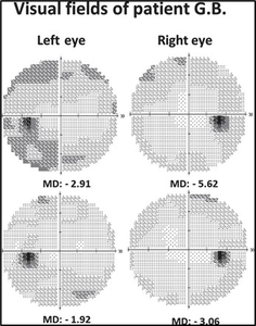 Visual fields of patient G.B.
