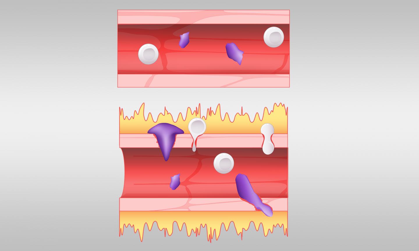 Computational Gene Study Suggests New Pathway for COVID-19 Inflammatory Response