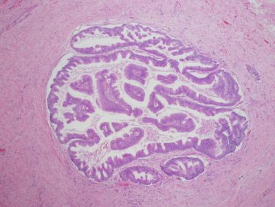 Pancreatic Cyst